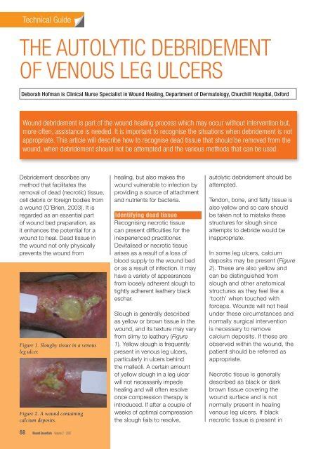 the autolytic debridement of venous leg ulcers - Wounds International