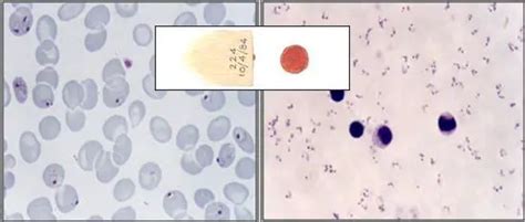 Thick and Thin Blood Smear for Malaria diagnosis - Learn Microbiology ...