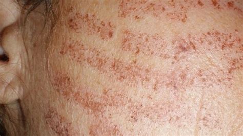 Laser hair removal burns: causes, symptom and treatment