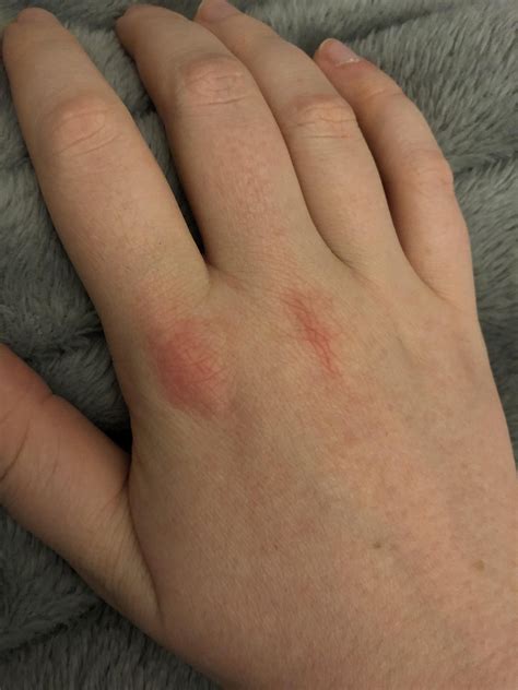 Do any of you have knuckle/hand pain and swelling? : r/ehlersdanlos