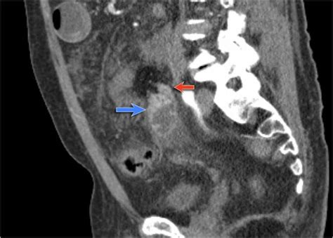 The Radiology Assistant : Closed Loop Obstruction in Small bowel obstruction | Small bowel ...