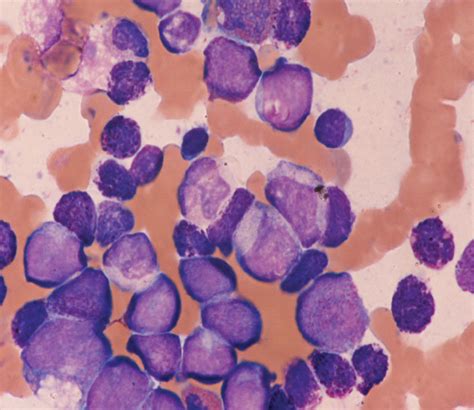 Bone marrow aspirate at diagnosis. | Download Scientific Diagram