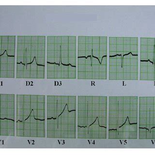 Electrocardiogram showing evidence of mild right ventricular overload. | Download Scientific Diagram