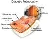 Diabetic Retinopathy: The Signs, Symptoms, and Solutions | Ocular Prosthetics, Inc.