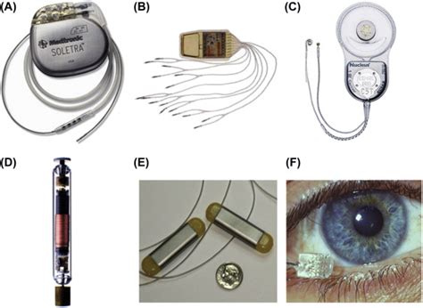 Implantable Neural Stimulators | Neupsy Key