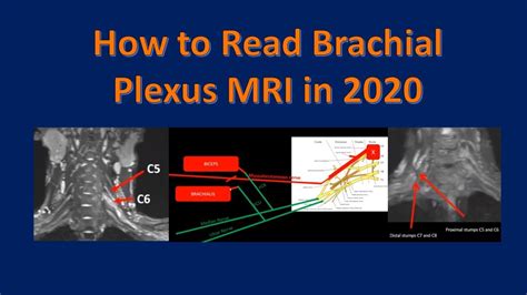 Brachial Plexus Anatomy Mri