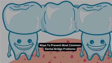 Dental Bridge Problems: Learn How To Prevent - Mesate