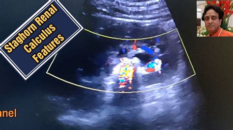 Staghorn Calculus Features and ultrasound treatment - YouTube