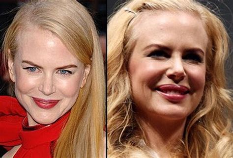 Nicole Kidman Plastic Surgery - Rumors or Facts?