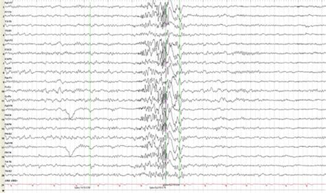 Juvenile Myoclonic Epilepsy (JME) | Epilepsy Foundation