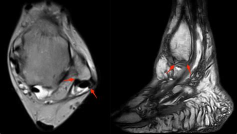 Peroneal Tendon Rupture | coachingultrasound