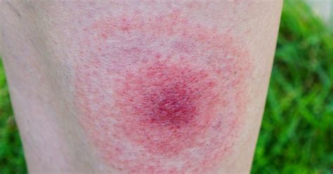 Lyme disease rash: Symptoms, stages, and identification