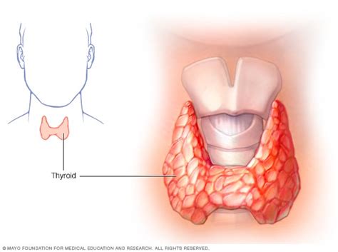 Hypothyroidism (underactive thyroid) - Symptoms and causes - Mayo Clinic