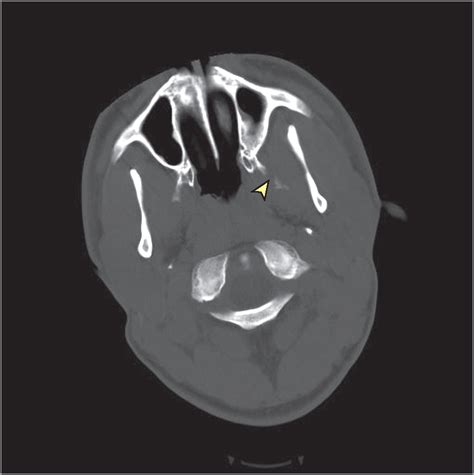 Lateral Pterygoid Plate Fractures and Jaw Fracture | JAMA Facial Plastic Surgery | The JAMA Network