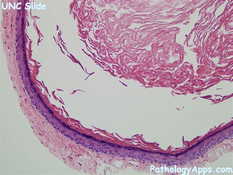 epidermoid inclusion cyst pathology