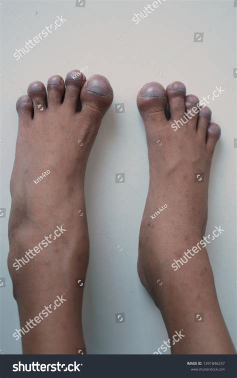 Patients Feet Show Clubbing Toes Typical Stock Photo 1391846237 | Shutterstock