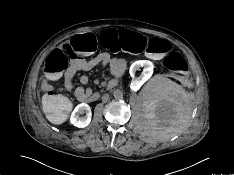 Spontaneous retroperitoneal haemorrhage after pulmonary thromboembolectomy surgery - Authorea