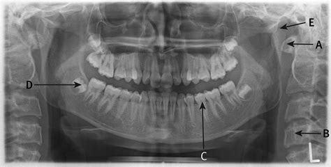 Interpreting a normal orthopantomogram | The BMJ