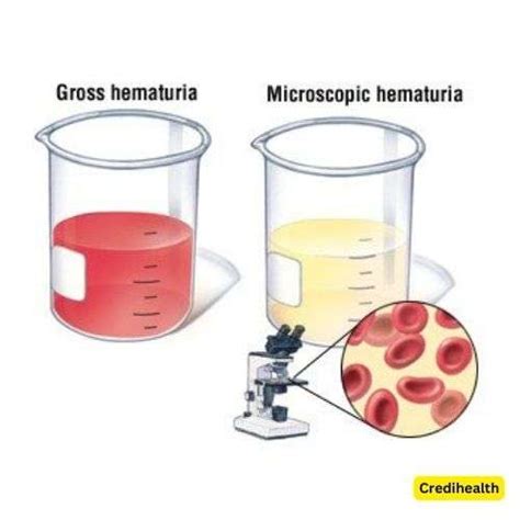 Blood in Urine (Hematuria Gross): Causes & Treatments | Credihealth