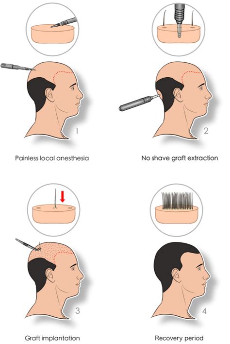 Hair Transplant Methods in Turkey | Vantage Hair Transplant Clinic Turkey