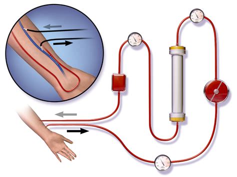 The Hemodialysis Process - United Dialysis Center