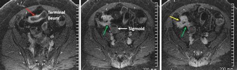 Small Intestinal Tests: Small Bowel Follow Through, CT Enterography ...