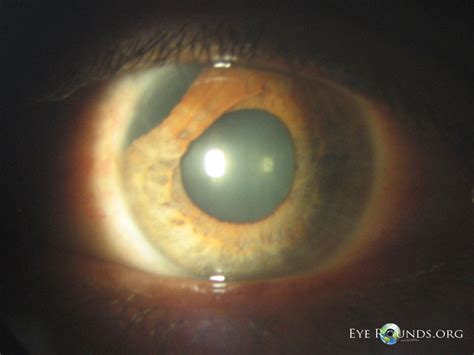 Iridodialysis . EyeRounds.org: Online Ophthalmic Atlas