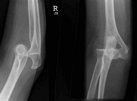 Elbow Dislocation • LITFL • Trauma Library