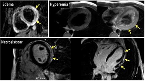 Diagnostics | Free Full-Text | Cardiac MRI and Myocardial Injury in COVID-19: Diagnosis, Risk ...