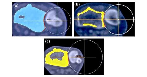 Morphological patterns of the sigmoid notch: (a) S-type notch, (b)... | Download Scientific Diagram