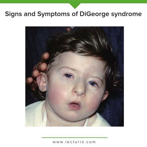 Pin By Nonas Arc On DiGeorge Syndrome Digeorge Syndrome,, 54% OFF