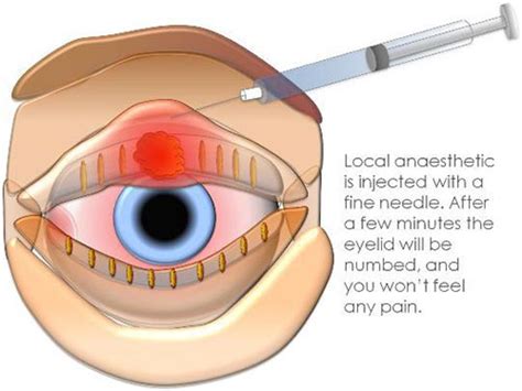 How To Remove A Stye From Your Eye : Place a warm washcloth over your closed eye.to relieve pain ...