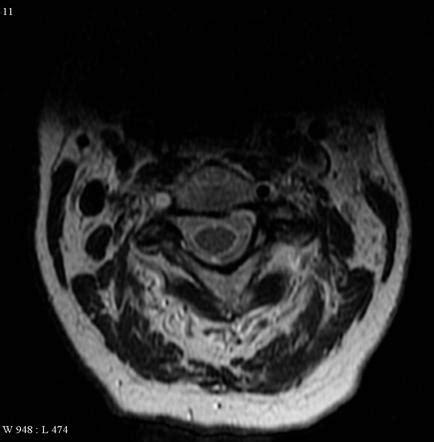 Vertebral artery dissection | Radiology Reference Article | Radiopaedia.org