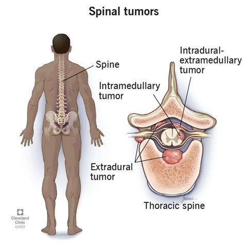 Spinal Tumors: Types, Causes, Symptoms & Treatment (2023)