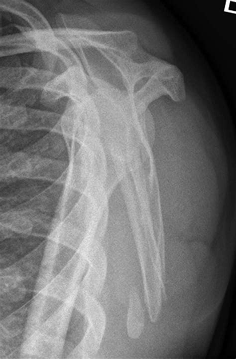 Inferior angle of scapula fractures: a review of literature and ...