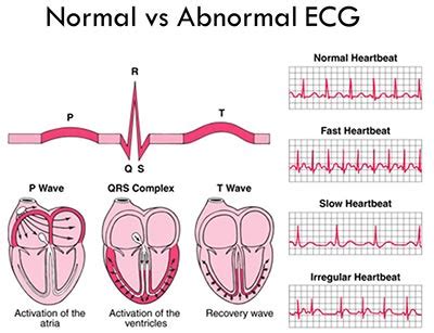 What is an Electrocardiogram? - Cardiovascular Institute of the Shoals