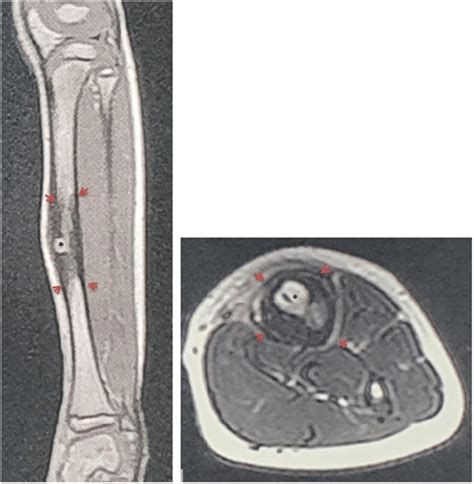 Brodie's abscess on MRI: Heterogeneous signal from the medulla of the... | Download Scientific ...