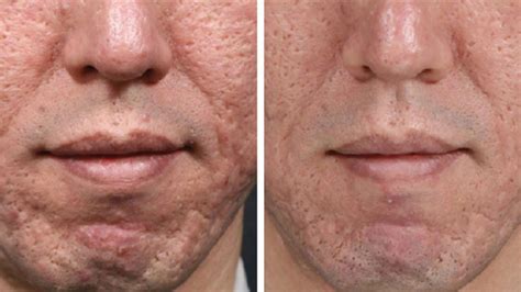 Microneedling for Acne Scars: Effectiveness, Side Effects, and Costs