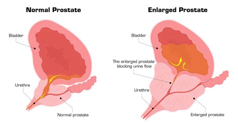 Benign Prostatic Hyperplasia