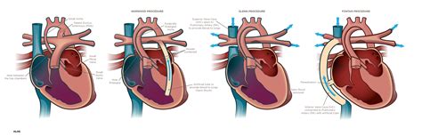 Hypoplastic Left Heart Syndrome Diagnosis & Treatment | Cardinal Glennon