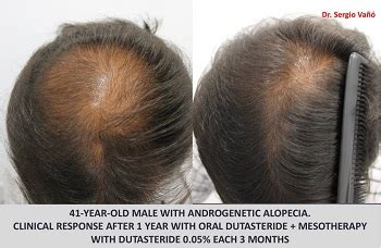 Dutasteride Archives | Hair Loss Cure 2020