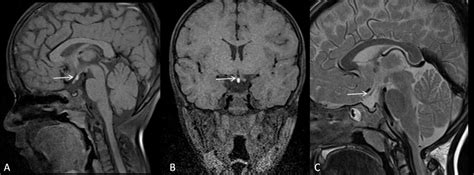 Pituitary Stalk Lesion Clinical Features - mapametawan