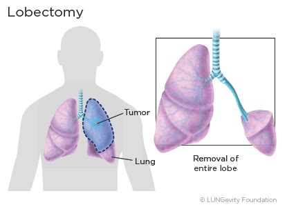 Surgery | LUNGevity Foundation