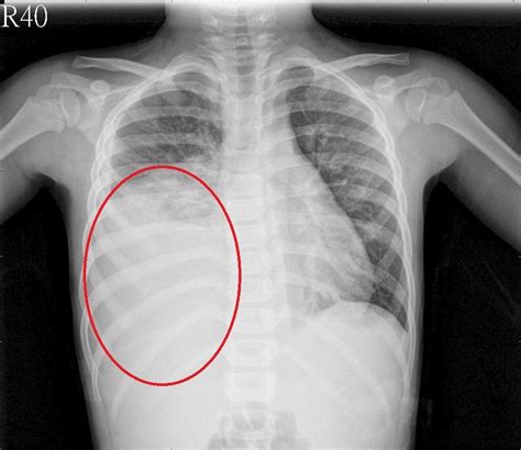 Symptoms Of Mycoplasma Pneumonia