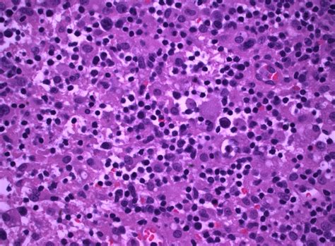 Pathology Outlines - T cell / histiocyte rich diffuse large B cell lymphoma