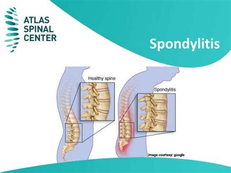 What is spondylitis | PPT