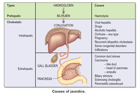 Evaluation of Jaundice - Manual of Medicine