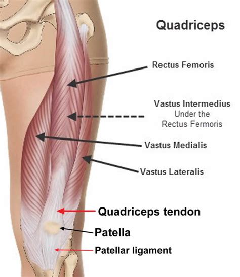 Ruptured quadriceps tendon causes, symptoms, diagnosis, treatment & recovery