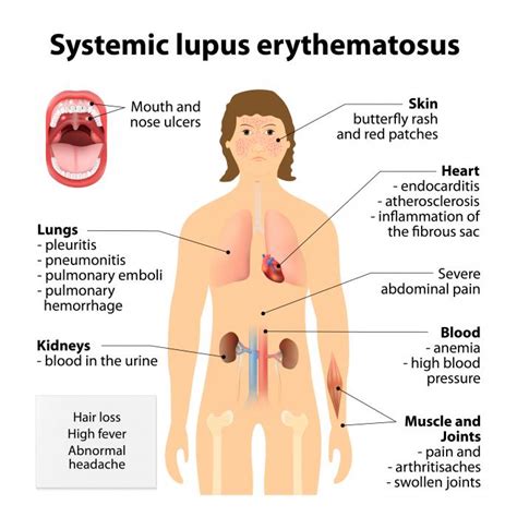 Lupus: a serious disease we know little about