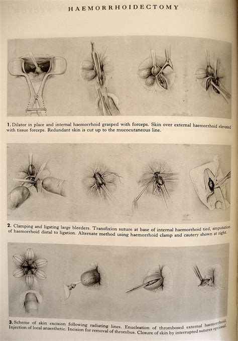 Manual of Operative Procedure: Haemorrhoidectomy | Anyone el… | Flickr